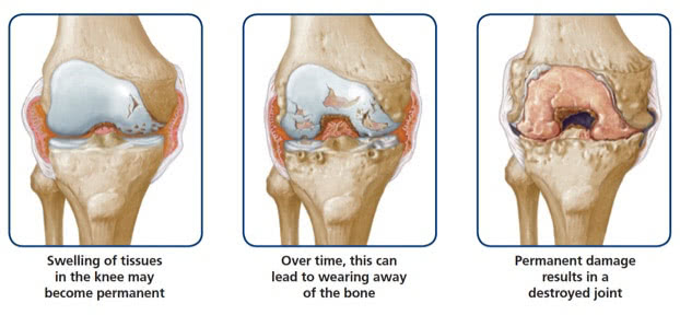 Changing Hemophilia illustration depicting how swelling of tissues in the knee may become permanent and how over time this can lead to wearing away of the bone, and eventually permanent damage and joint destruction