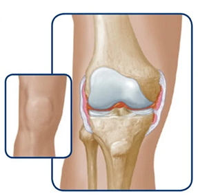 Knee swelling progression illustration