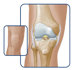 Knee swelling progression illustration