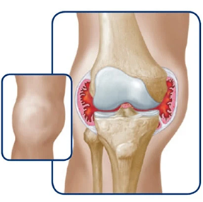 Knee swelling progression illustration