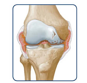 Knee with permanent damage progression illustration