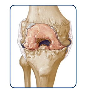 Knee with permanent damage progression illustration