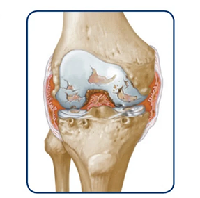 Knee with permanent damage progression illustration
